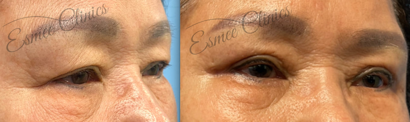 Before and After img